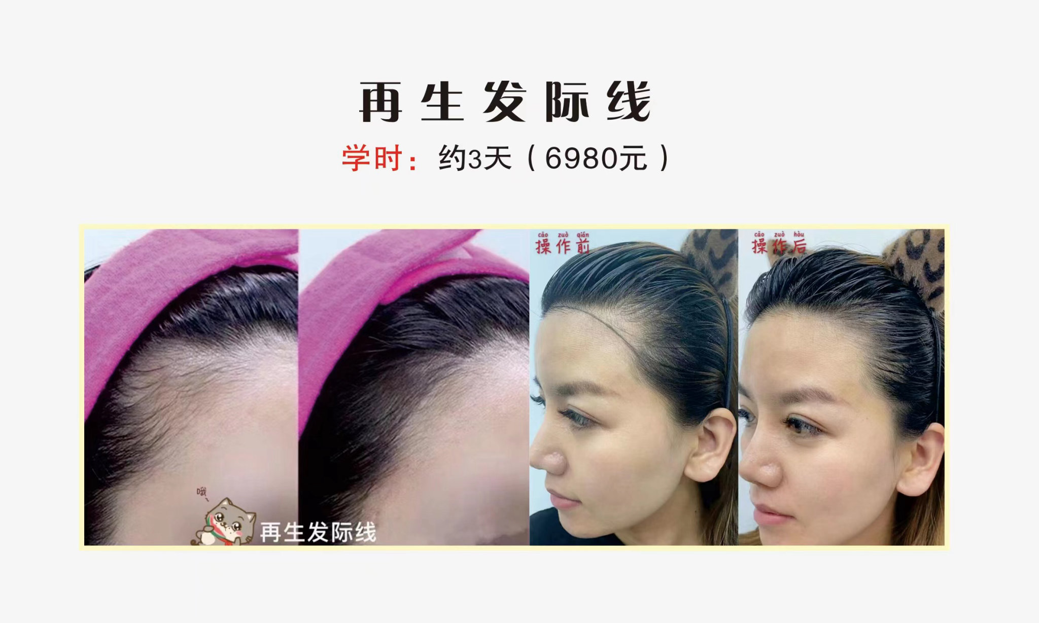 再生发际线